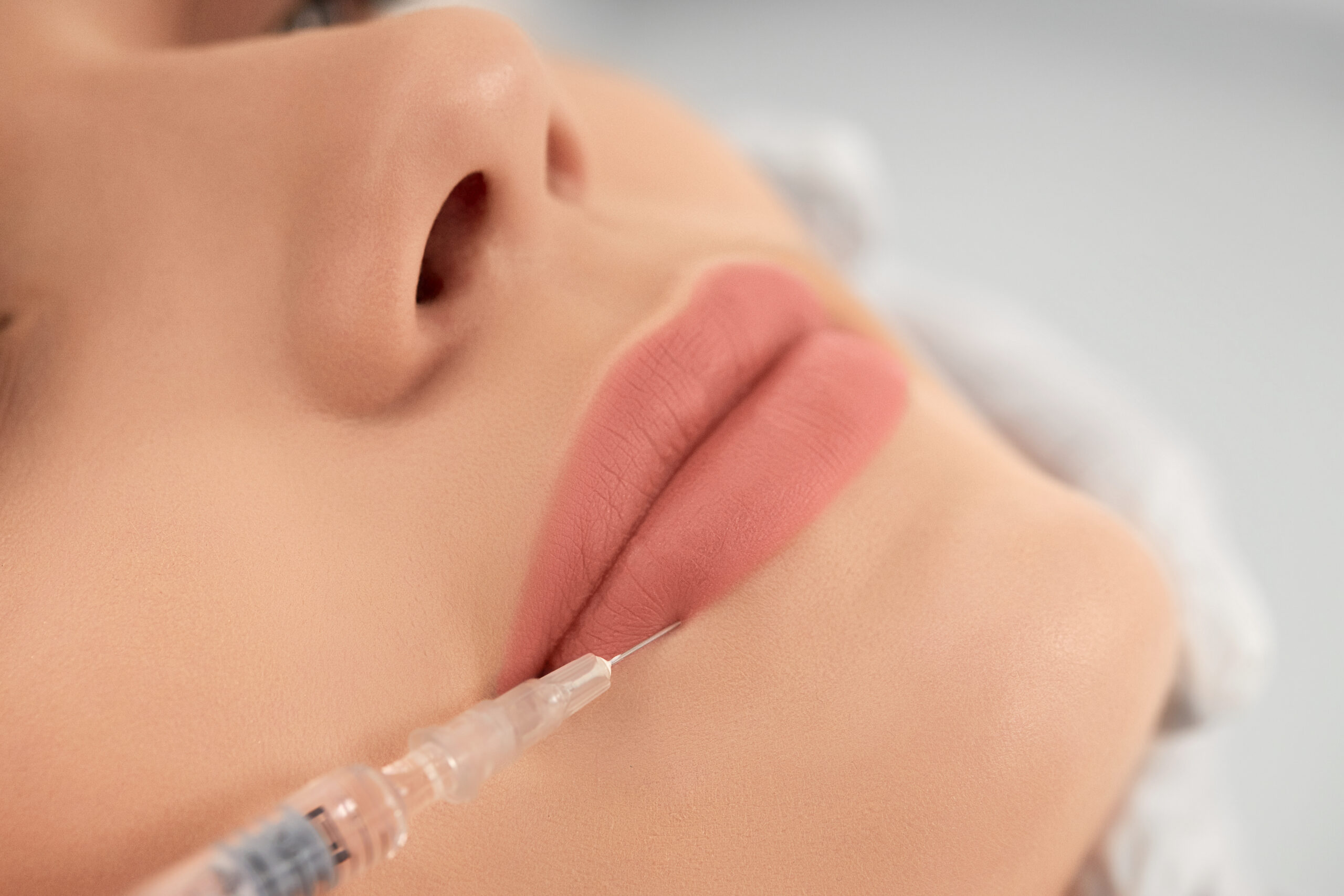 Subtle lip enhancement and reduction of fine perioral lines with dermal fillers.