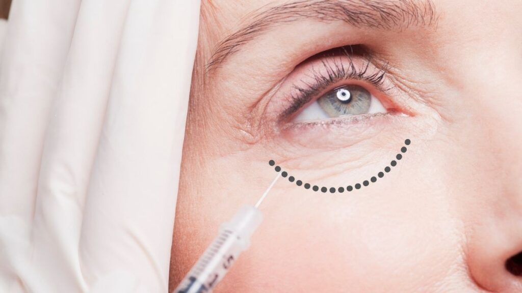 A lady being treated with polynucleotides in Colchester to address crepy skin in the under eye / tear trough.