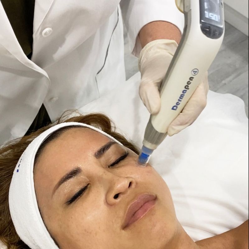 Dermapen microneedling pricing in Colchester at doctor-led Bespoke Medical Aesthetics clinic.